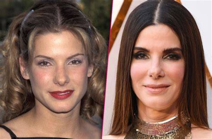 Sandra Bullock Fillers Puffy Cheek Fail