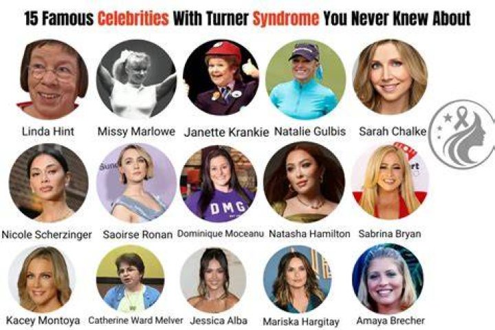 Turner Syndrome Celebrities: Uncovering Triumphs And Inspiration