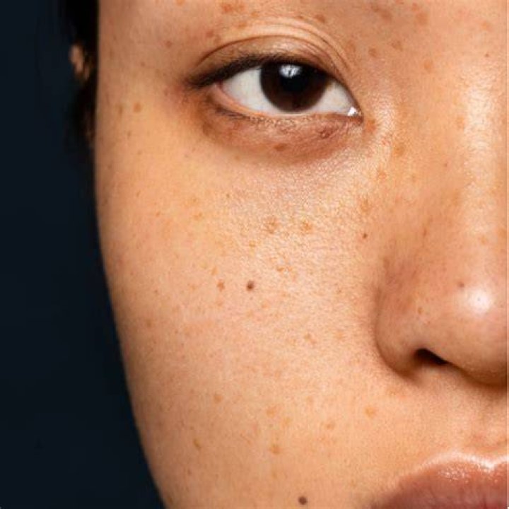 Unveiling Secrets For Dark Spot Transformation